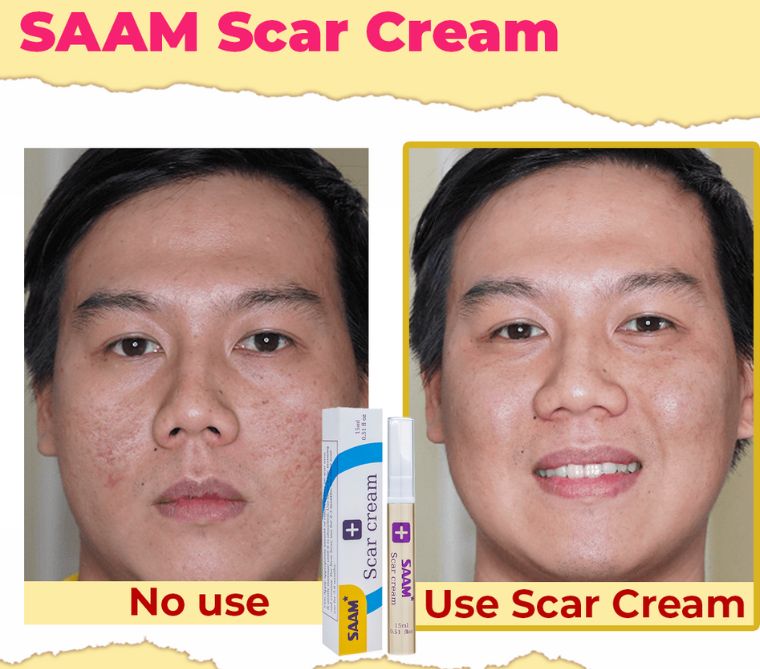 Saa Scar Cream Fade Minor Scars & Achieve Even Skin Tone
